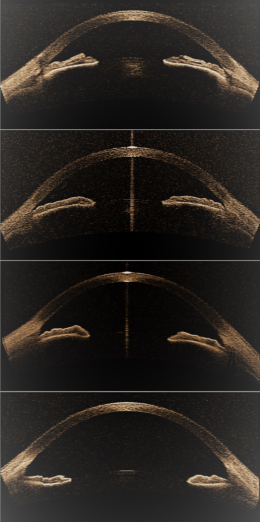 Image processing method for glaucoma detection and computer program