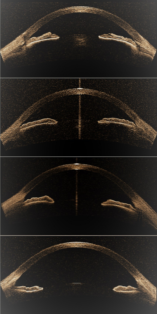 Image processing method for glaucoma detection and computer program